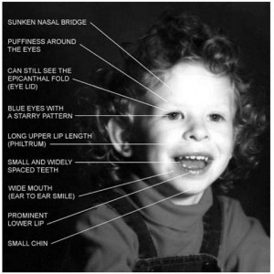Figure 1. Facial features of Williams syndrome.