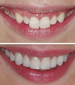 Crooked Teeth Veneers Before And After