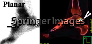 Posterior impingement syndrome Planar image shows intense uptake in