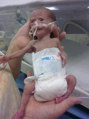 Precious preemie babies low birth weight baby. These precious humans ...
