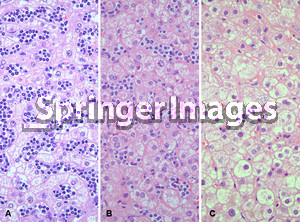 time of diagnosis showing prominent sinusoidal infiltrate by lymphoma ...