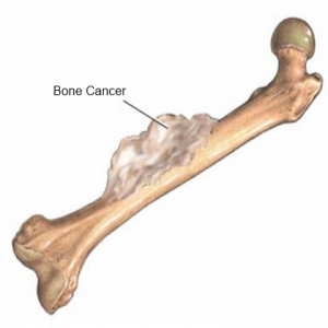 bone cancer treatment