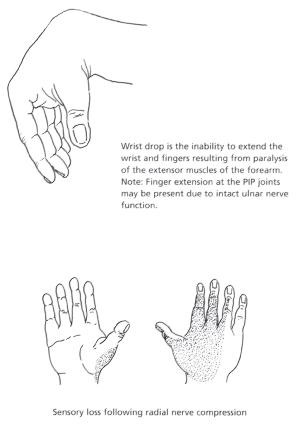 Radial Nerve Compression