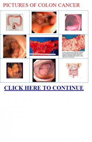 pictures of colon cancer - Doctor Examining