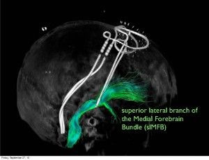 ... : Implanted Electrodes Reboot Brain out of Intractable Depression