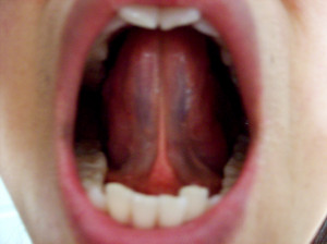 What Does a Healthy Tongue Look Like