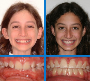 palate expander before and after