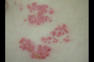 Shingles Picture Slideshow