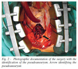 Innominate Artery Bypass