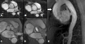 Non Coronary Cusp Aortic Valve