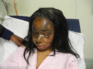 The horrific injuries sustained by acid attack victim Naomi Oni have ...