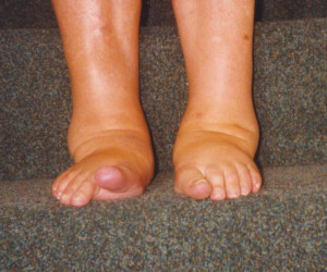 Psoriatic Arthritis Feet Psoriatic arthritis
