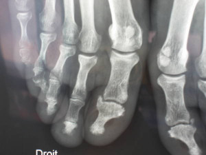 Psoriatic Arthritis Feet Psoriatic arthritis, foot