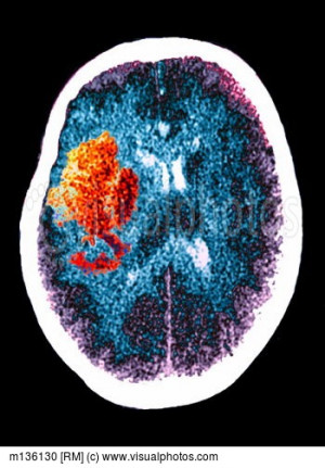 CT Of Brain Stroke