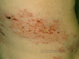 Shingles Symptoms And Signs