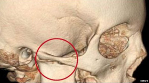 Liliana Cernecca's right jaw became fused to her skull