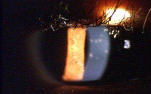 Aka epidemic keratoconjunctivitis cached similarmar cs wallhack 1.6 ...