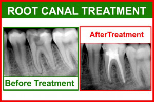 What to do when a Cavity Start to Hurt
