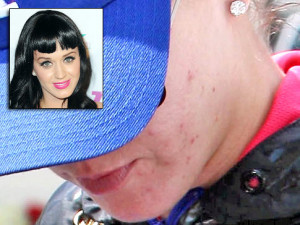 Katy Perry with pimples