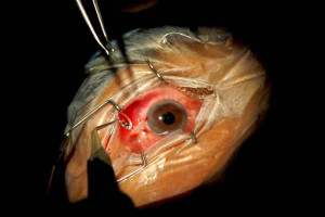 doctor attaches a new lens onto an eye during cataract surgery