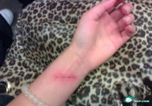 girl cutting wrist scars