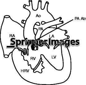 Pulmonary Atresia Patent Ductus Arteriosus