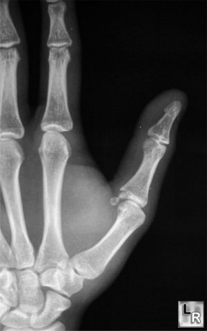 Normal Right Thumb X Ray With a broken thumb.