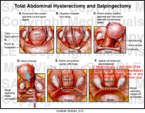 Total Abdominal Hysterectomy Procedure