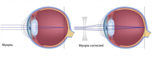 Myopia (short-sightedness)
