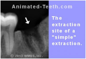 Extraction of Impacted Wisdom Teeth