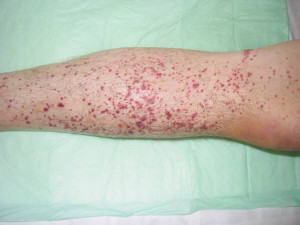 Skin biopsy is the gold standard for the diagnosis of cutaneous ...