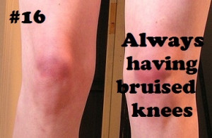 Volleyball problems….my knees are so ugly right now