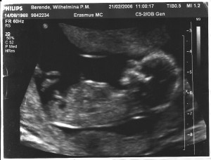 12 3 week scan boy or girl update it s a boy in gender com