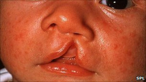 The risk of cleft lip goes up by 28% if the mother is a smoker