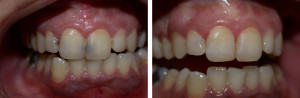 Filling Cavities On Front Teeth