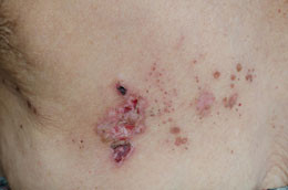 Related to What Is Disseminated Herpes Zoster With Pictures