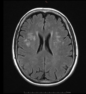 Lesion On Brain MRI White Matter