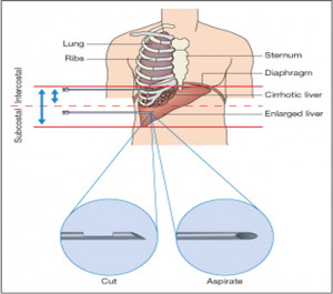 Liver Biopsy