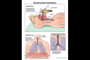 Intubation Vocal Cords