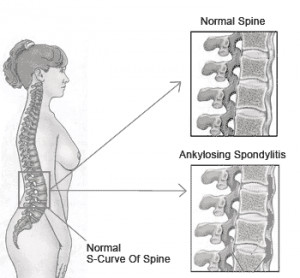 ankylosing spondylitis Images and Graphics