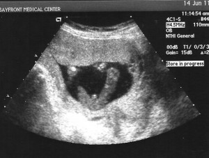 17 weeks pregnant ultrasound gender