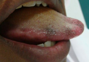under Tongue Tip Side Pictures of Dark Marks on Tongue Black spots on