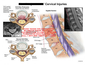 Thecal Sac Cervical Spine Cervical and axial views of