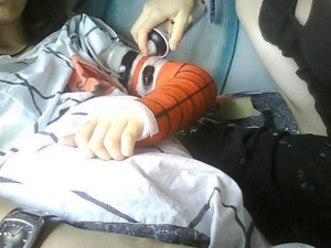 Spiderman Cast for a Broken Arm (4 pics)