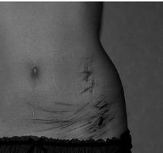Black and White skinny self harm cutting cuts scars More