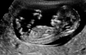 2nd trimester ultrasound photo.PNG