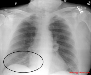 Pulmonary Embolism On Chest X ray