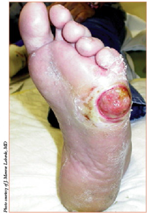 Symptoms of Diabetic Foot Ulcers