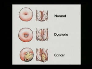 Cervical Cancer Survivor Quotes Cervical cancer; the media