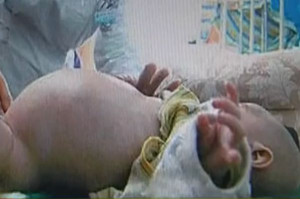 to the hospital after his stomach had nearly tripled in size and stuck ...